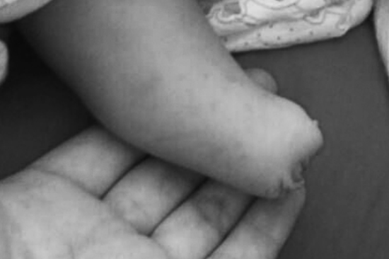 产检做7次B超医生均说正常 孩子出生却没右脚