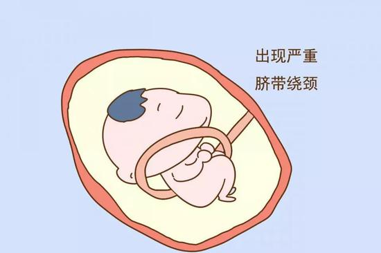 胎儿出现严重脐带绕颈